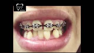 BIMAXILLARY PROTRUSION  BRACES 917006740026 anantnag dentistry health aestheticsyoutube trend [upl. by Hoopes]