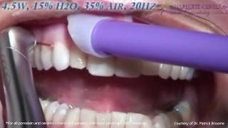 Crown and Veneer Removal  Fast amp Easy with Waterlase Laser Dentistry [upl. by Sido254]