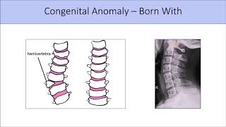 Congenital Spinal Defects  12 of Population Have These [upl. by Gomer]