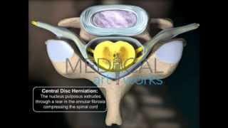 3D Medical Animation  Cervical spine posterior central disc herniation [upl. by Thorrlow990]