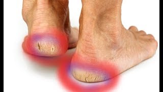 How to Repair Cracked And Dried Feet At Home Fast  Dry Cracked Heels Treatment [upl. by Sirob]