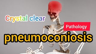 Pneumoconiosis  Pathology  MAT Medicos [upl. by Damaris]