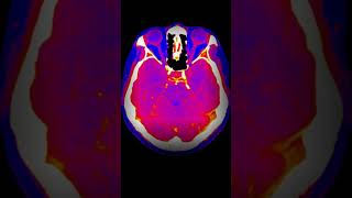 Neanderthal Brains Were Different [upl. by Resiak]