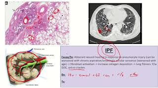 Diffuse Parenchymal Lung Disease ILD Part 2 [upl. by Melia]