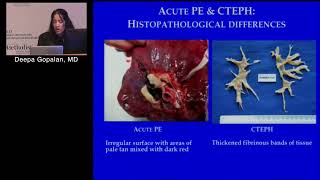 Chronic Thromboembolic Pulmonary Hypertension Deepa Gopalan MD [upl. by Llekcor]