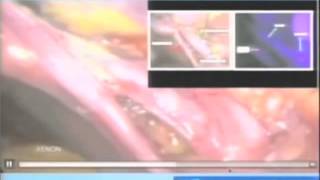 Intraoperative Incisionless Fluorescent Cholangiography  Ep 16 [upl. by Llevol]