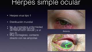 herpes simple ocular [upl. by Nowell]