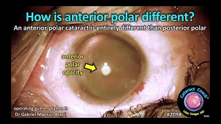 CataractCoach™ 2098 How is anterior polar cataract different [upl. by Musser]