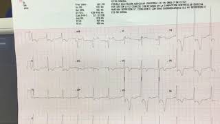 CARDIOMIOPATIA HIPERTROFICA CON CAMBIOS ECG CLÍNICOS ECOCARDIOGRAFICOS  CASO CLÍNICO [upl. by Nolly]