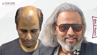 Does Hair Transplant Really Change Life [upl. by Ardell]