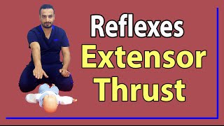 02 Extensor Thrust Reflex [upl. by Berman753]