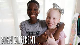 My Twin Sister Has Albinism  BORN DIFFERENT [upl. by Briggs]