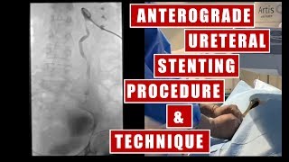 Transnephrostomy Ureteral Stent placement under fluoroscopy guidance procedure and technique [upl. by Eeliab591]