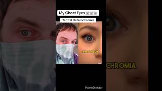 Central Heterochromia Doctors Opinion [upl. by Yarased]