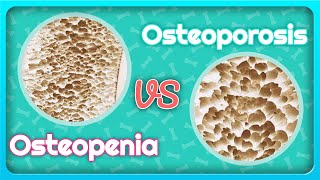 Osteoporosis vs Osteopenia Whats the Difference [upl. by Len]