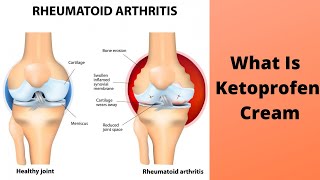 What Is Ketoprofen Cream [upl. by Nede44]