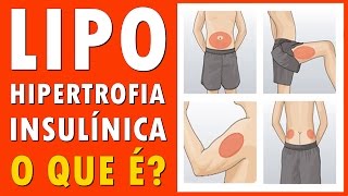 Lipohipertrofia  Insulínica  O que é Tratamento Causas por Insulina Diabetes Tem Cura [upl. by Marys]