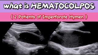 What is Hematocolpos Ultrasound  Imperforate Hymen  Blood in Vagina [upl. by Cara]