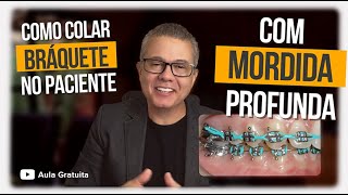 COMO COLAR BRÁQUETE NO PACIENTE COM MORDIDA PROFUNDA  Ortodontia com o Professor Hélio Venâncio [upl. by Etteluap]