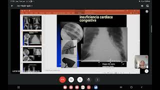 RADIOLOGIA DE TORAX PARTE 4  RADIOLOGIA [upl. by Rabin]