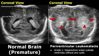 Neonatal Brain Ultrasound Normal Vs Abnormal Images  Full Term Infant amp Premature Newborn Head USG [upl. by Marlow]