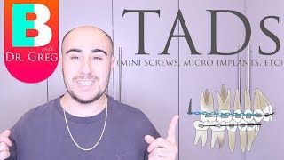 BRACES EXPLAINED TADs  Mini Implants [upl. by Ailadi]