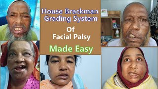 House Brackman Grading System of Facial Nerve Palsy Made Easy [upl. by Anoirtac30]