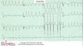 ECG Interpretation Tutorial  ChalkTalk 26 Advanced Level [upl. by Assedo]