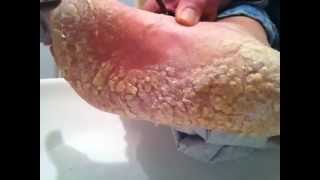 Dry cracked foot skin [upl. by Lunseth]