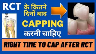 रुट कैनाल के कितने दिनों बाद दांतो की कैपिंग करनी चाहिएRIGHT TIME TO FIX CAP AFTER RCTDrPBhatia [upl. by Aivalf]