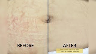 Fractional CO2 Laser Say Goodbye To Stretch Marks  Shinagawa Aesthetics [upl. by Marela]