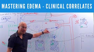 Mastering Edema  Types Causes Symptoms amp Treatment 👨‍⚕️ [upl. by Donna]