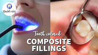 Composite Fillings  Composite filling procedure  Composite bonding to the tooth [upl. by Kola]