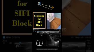 SIFI  PENG Blocks  Scanning Principles  Ultrasoundguided shorts regionalanesthesia DrTuhinM [upl. by Phylis556]