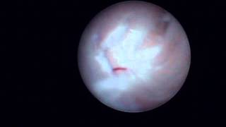 Arthroscopy of the Jaw Temporomandibular Joint TMJ  Part 3 [upl. by Enyahs]