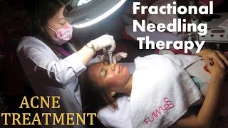 ACNE SCARS Treatment  Fractional Needling Therapy Review Demo and Result [upl. by Vasilek]