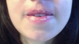 Surviving Accutane 1 Extremely Dry Lips [upl. by Riaj514]