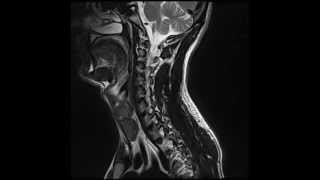 MRI  Incomplete T7 Spinal Cord Injury [upl. by Charmaine]