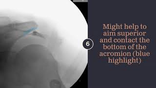 1 Minute Shoulder Subacromial Bursa Injection [upl. by Einaoj523]