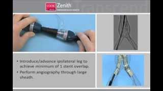 Endovascular Graft Zenith AAA Flex [upl. by Graham753]