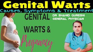 genitalwartswartswartstreatmentgenital warts symptomsrisk factorscausesfoods and treatment [upl. by Salguod289]