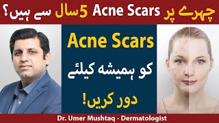 Treatments for ACNE SCARS Kaise Hataye  Acne Scars Removal  How To Remove Acne Scars [upl. by Attenauqa]