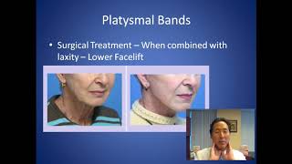 How Can I Soften the Look of my Neck  Platysmal Bands Consultation  Dr Anthony Youn [upl. by Lunette636]