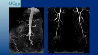 Endovascular Approaches for TASC CD Aortoiliac Lesions  UCSF Vascular Surgery Symposium 2013 [upl. by Anuahsat]