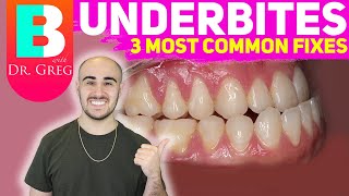 BRACES EXPLAINED Underbite  Crossbite Correction [upl. by Stutsman491]