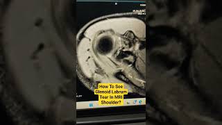 How To See Glenoid Labrum Tear In MRI Shoulder drsaichandra shouldermri [upl. by Artina]