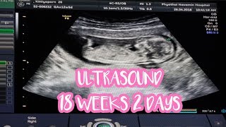 อัลตร้าซาวด์ 12 สัปดาห์ 5 วัน  Ultrasound 12 weeks 5 days pregnant  Cherte [upl. by Mullac68]