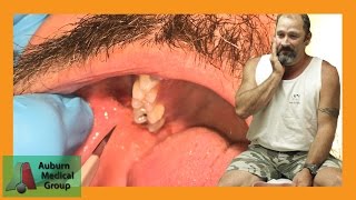 PAINFUL DENTAL ABSCESS DRAINED  Auburn Medical Group [upl. by Schiffman]