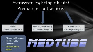 ECGs abnormal rhythms Extrasystoles [upl. by Dnaltroc]