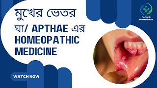 মুখের ঘা  APTHAE এর সমস্যা সমাধানের অসাধারণ HOMEOPATHIC MEDICINE [upl. by Yahsel]